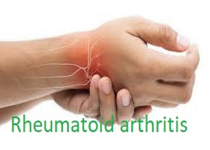 Rheumatoid Arthritis