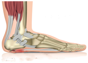 Plantar Fasciitis